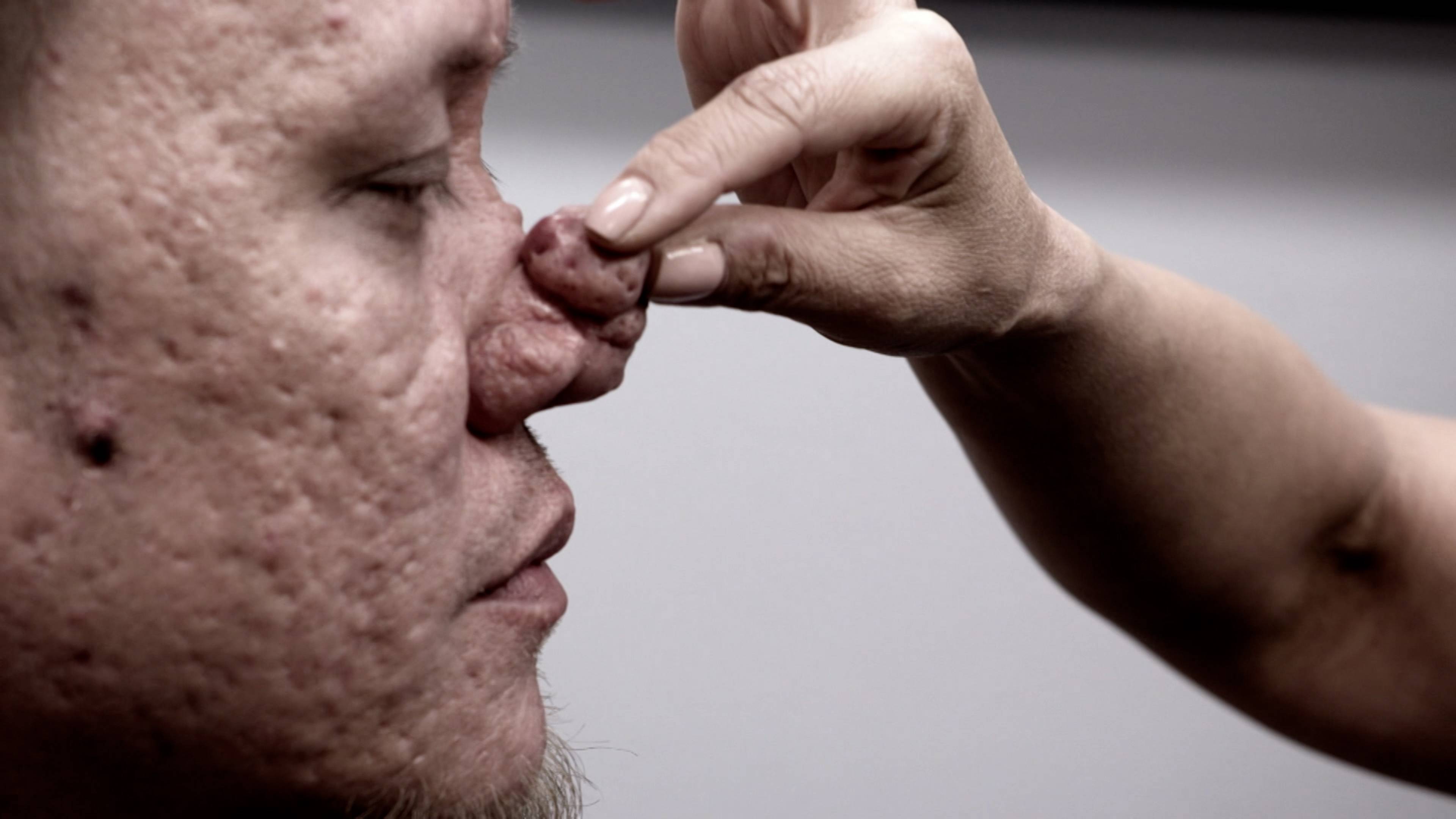 أنف بلا حدود