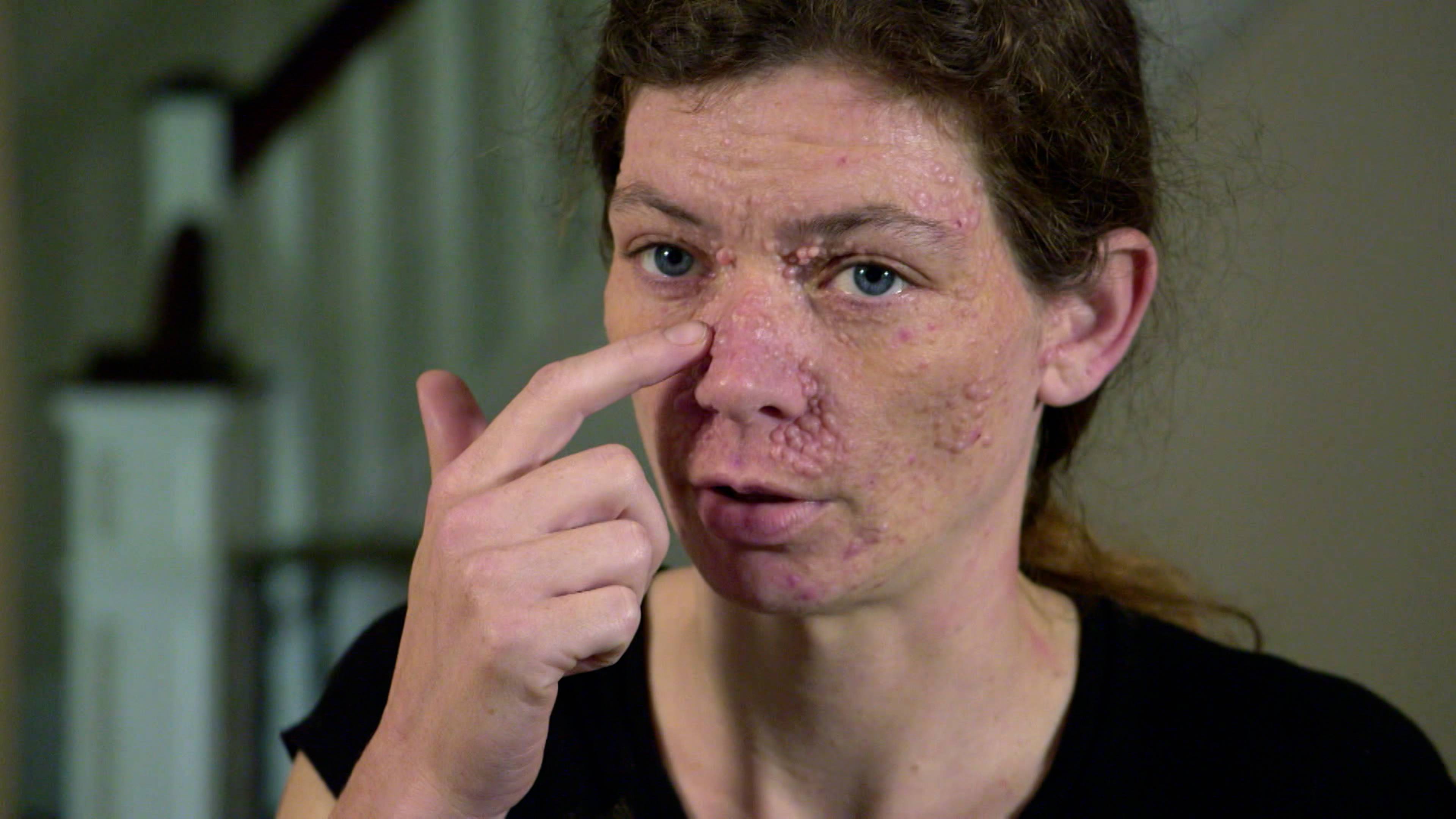 مئات الأورام