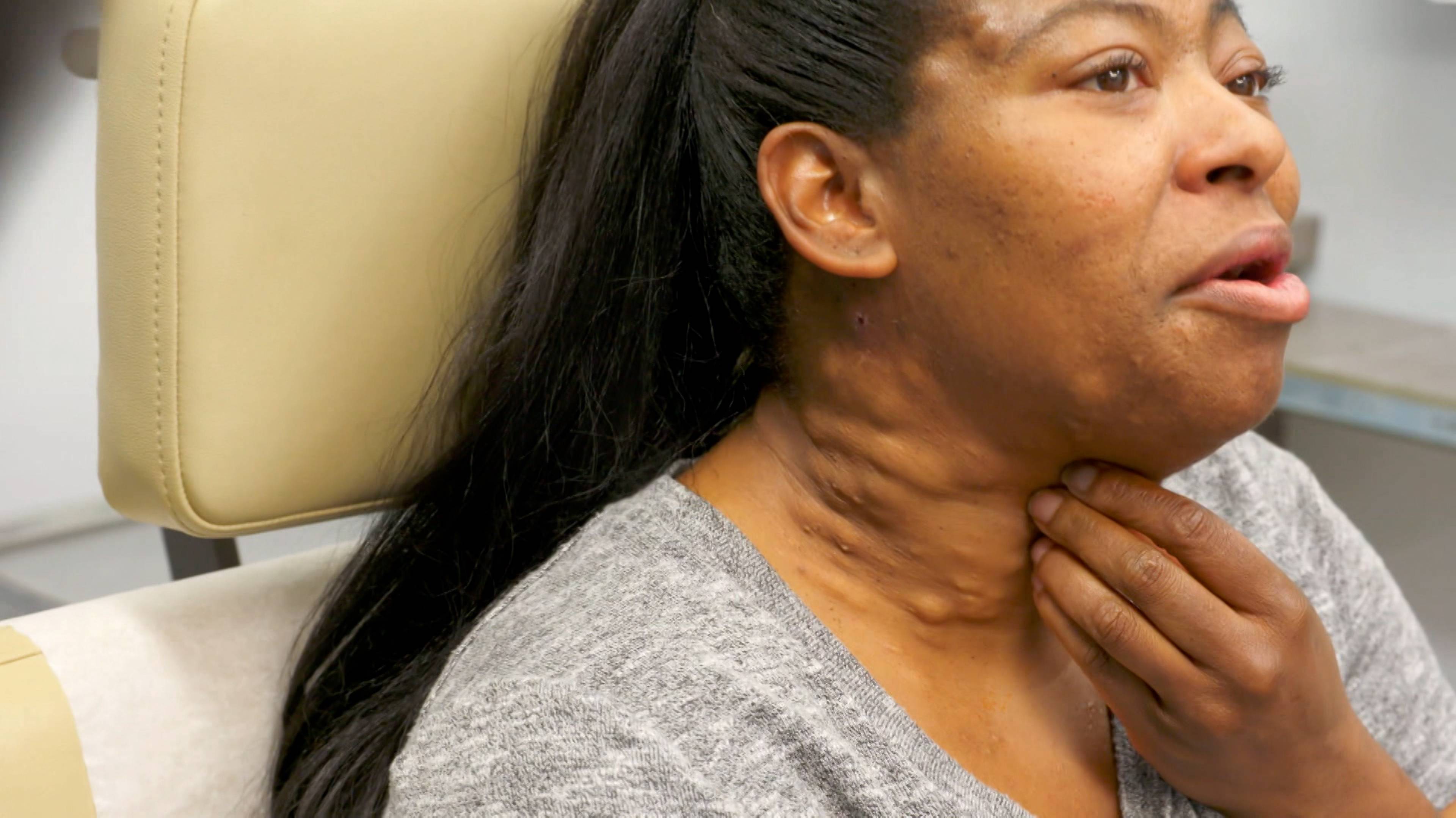 الورم في العين